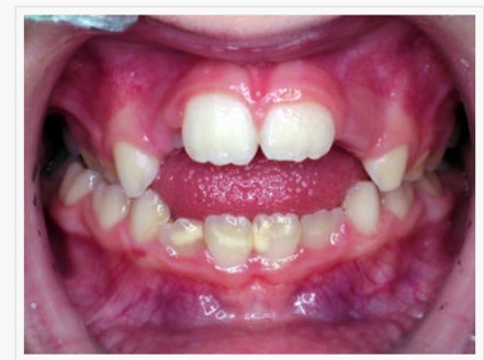 Problemi occlusione bambini - caso 1