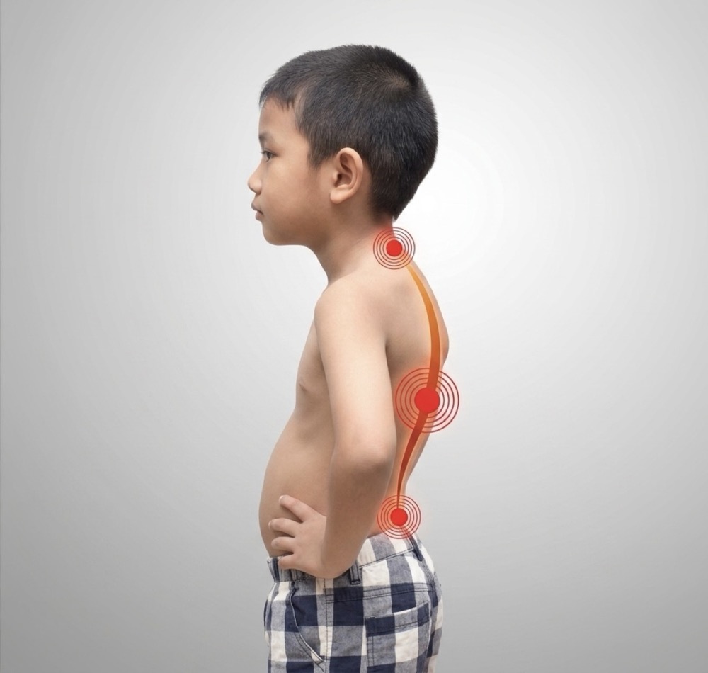 Ipercifosi bambini - correzione posturale
