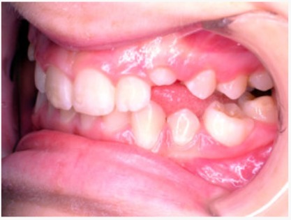 Problemi occlusione bambini - caso 2