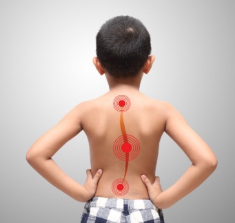 Scoliosi bambini - valutazione posturale