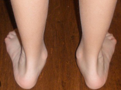 Problemi ai piedi bambini - trattamento posturale